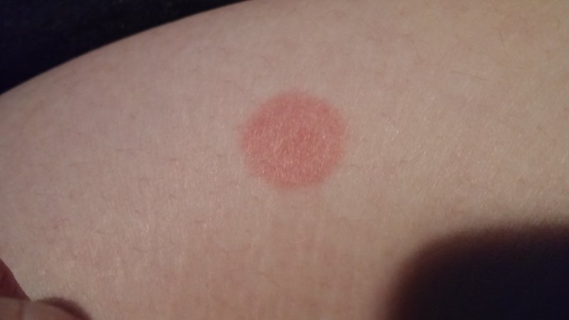 Red Patch Skin rash