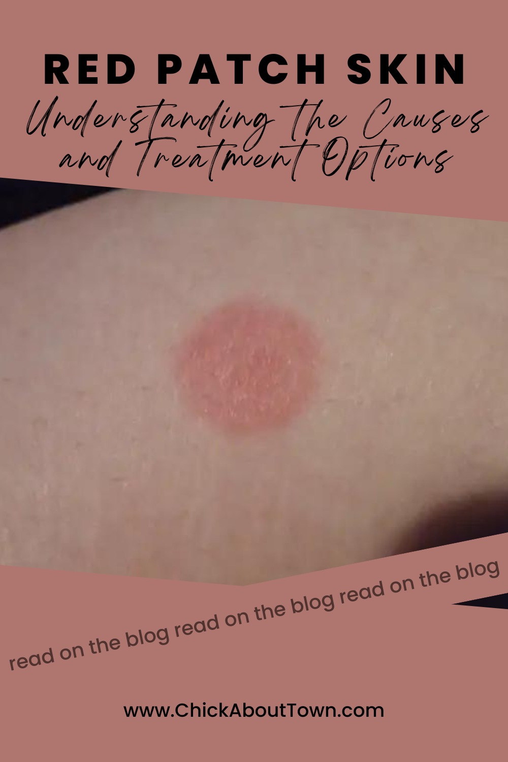 8 Causes For A Red Patch Skin And Fast Things To Do About It Today