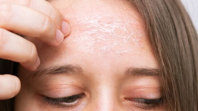 dry skin patches on skin